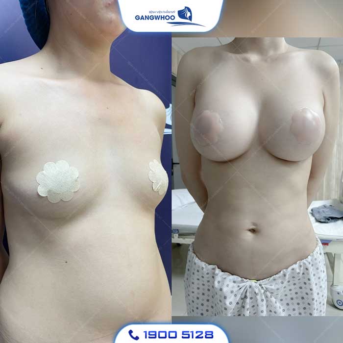 Nâng ngực không cần phẫu thuật: Giải pháp hiệu quả và an toàn